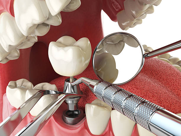 Best Broken or Cracked Tooth Emergency Dentist in Lemon Hill, CA